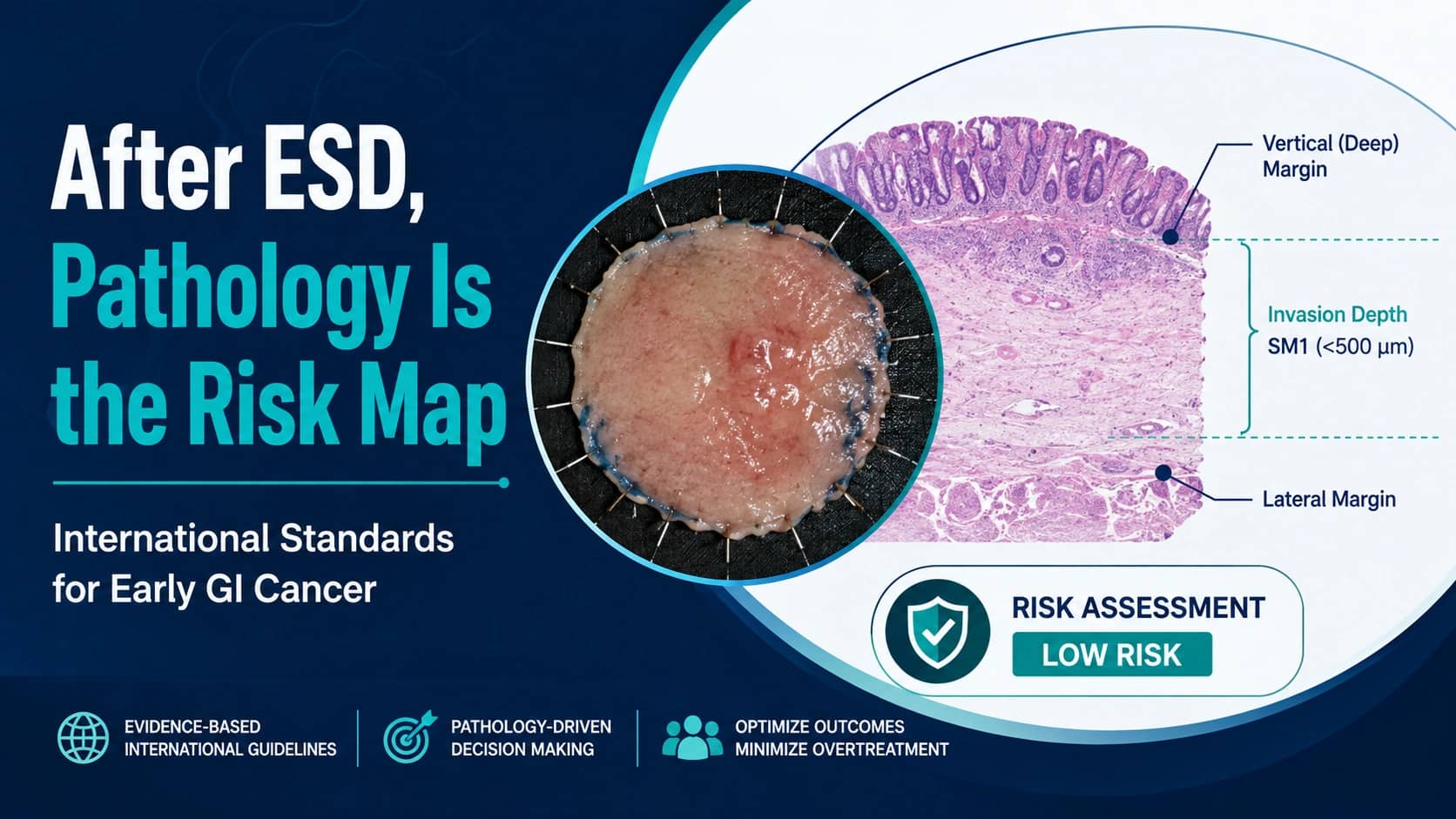 After ESD, the Pathology Report Becomes the Risk Map: International Standards for Early GI Cancer