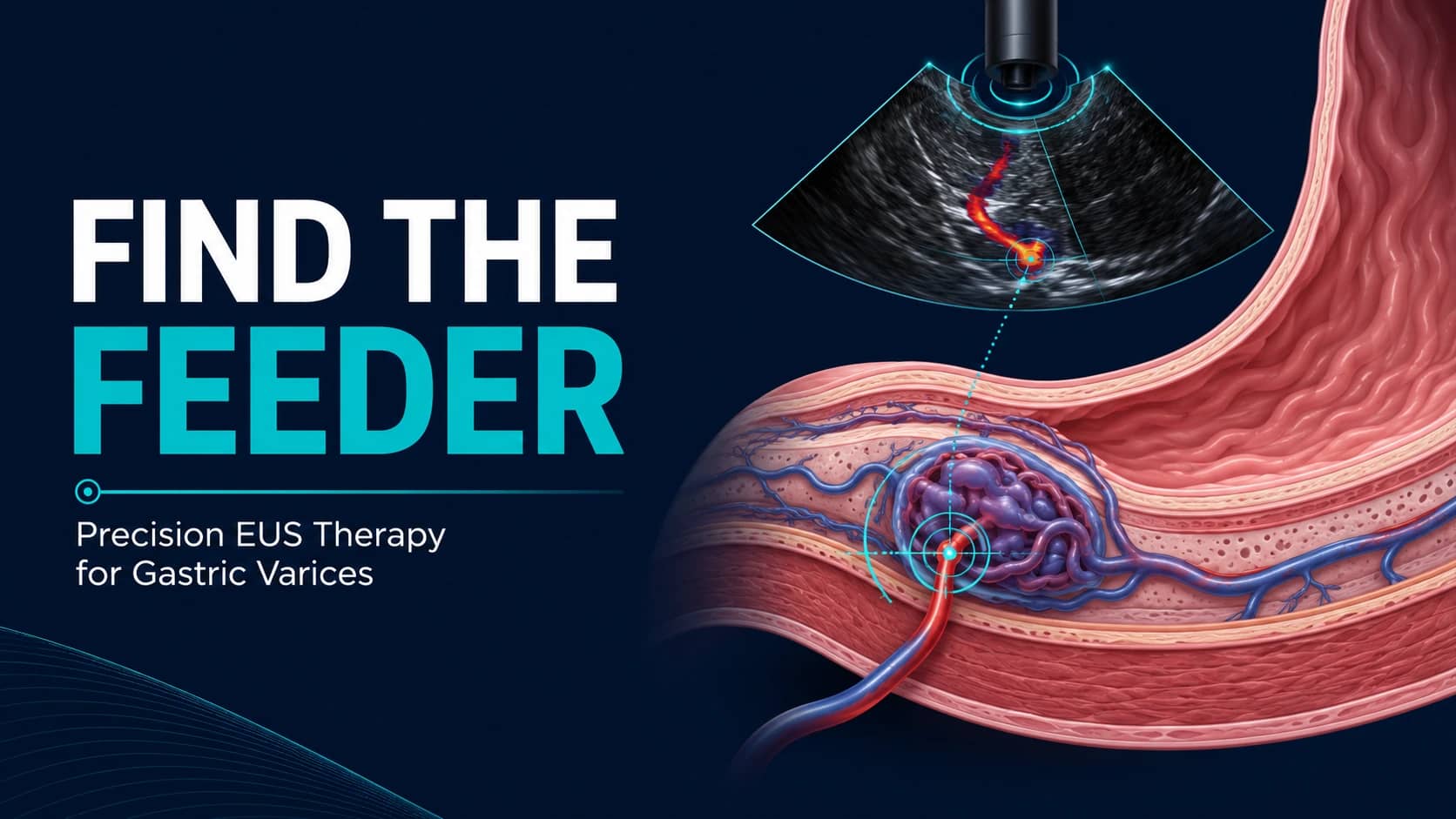 Find the Feeder: What Precision EUS Targeting May Change in Gastric Variceal Therapy