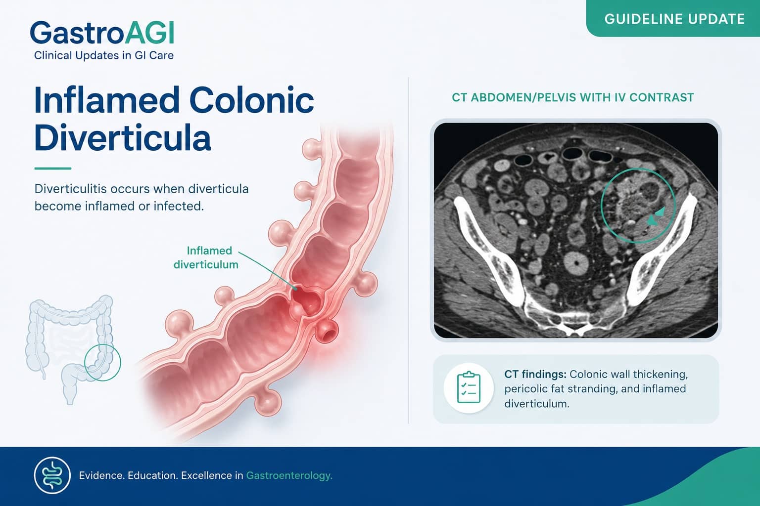 ACG 2026 Diverticulitis Guideline: CT Confirmation, Selective Antibiotics, and Smarter Follow-Up
