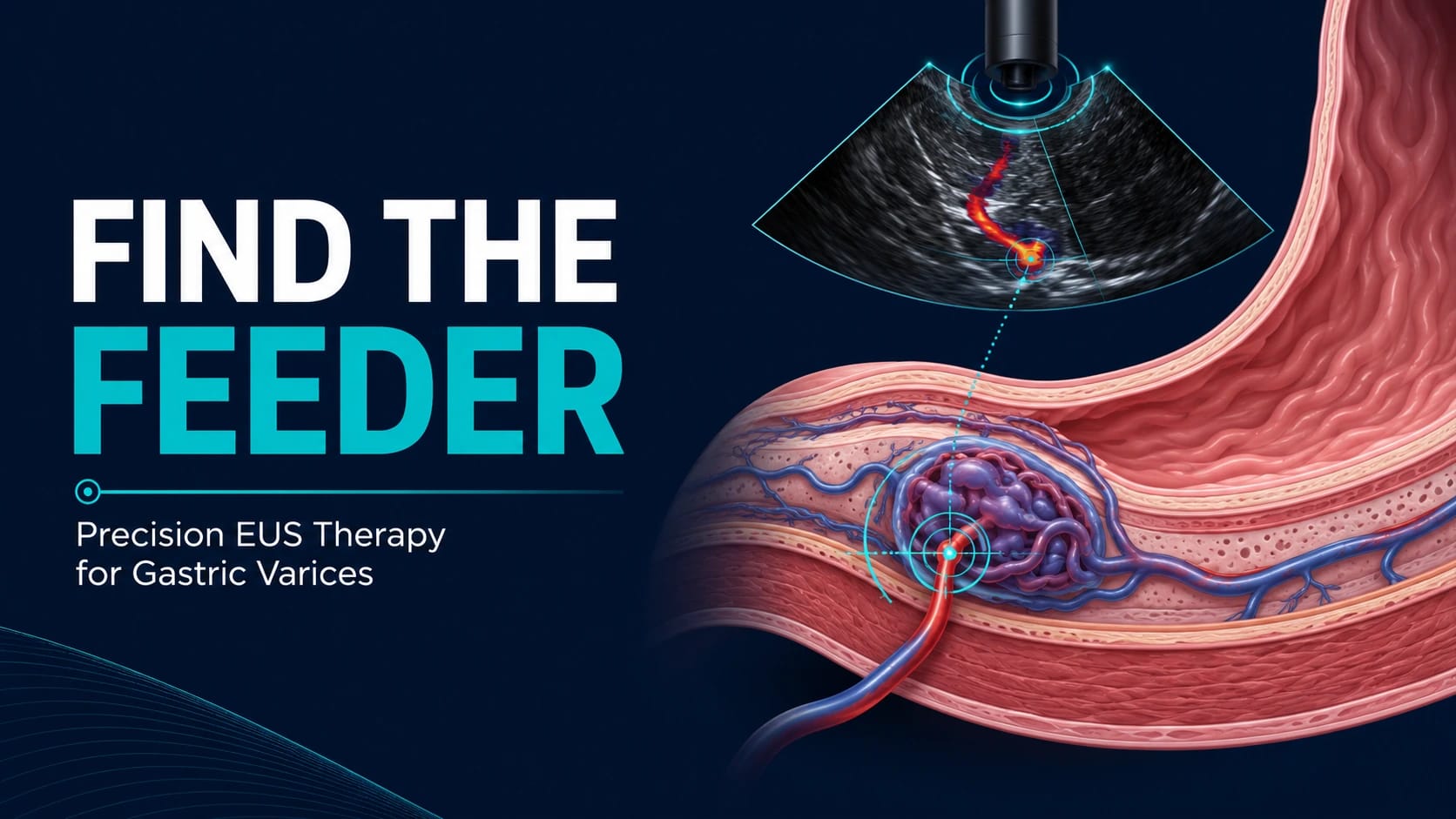 Find the Feeder: What Precision EUS Targeting May Change in Gastric Variceal Therapy