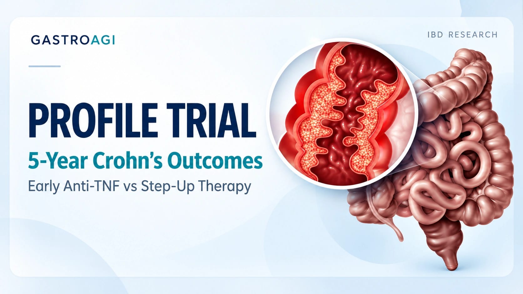 Early Anti-TNF for Crohn's Disease: What the 5-Year PROFILE Follow-Up Reveals
