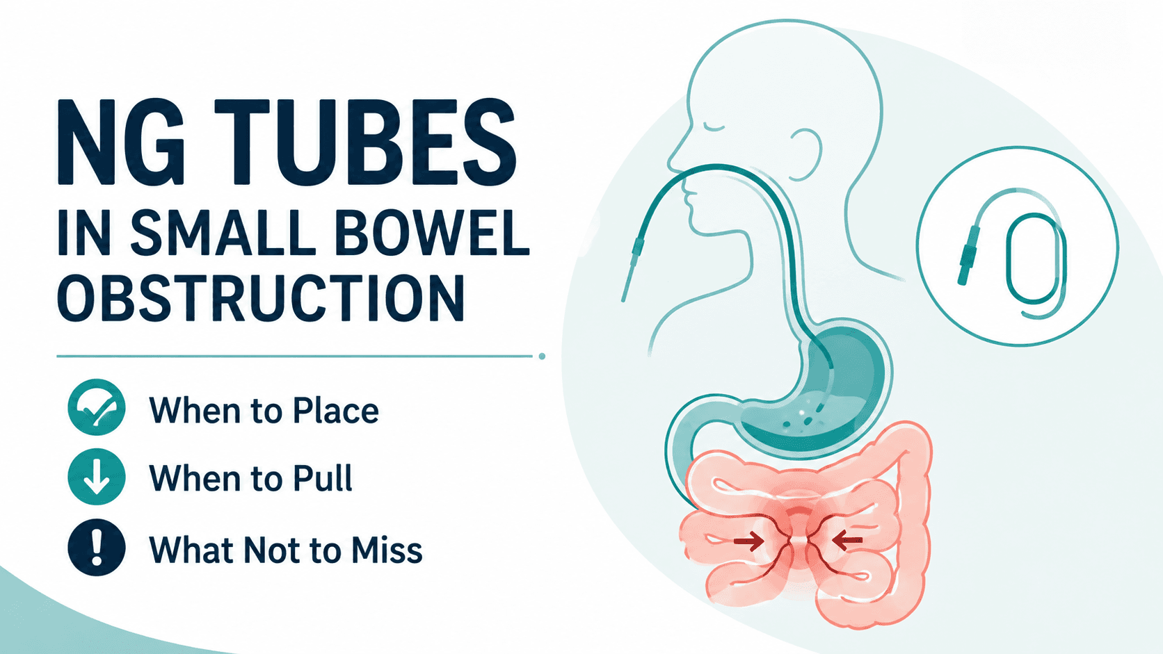 NG Tubes in Small Bowel Obstruction: When to Place, When to Pull, and What Not to Miss