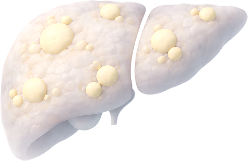 Fatty Liver Disease