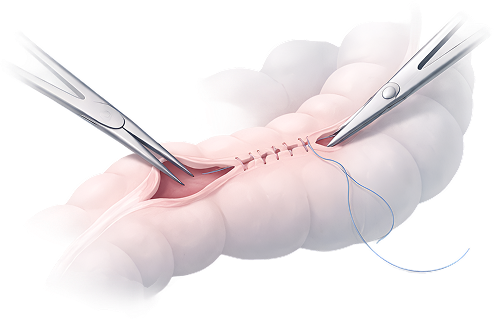 GI Surgery