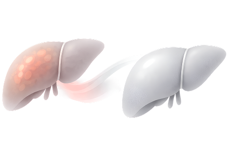 Liver Transplantation